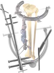 images/DePuy_Ace.jpg